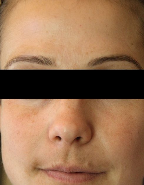 After a customized medical-grade treatment-and-home-care plan at Neoderma: the same face with the pigmentation faded, eyes covered for privacy