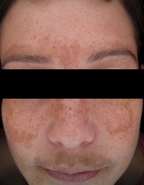 Before: melasma and pigmentation across a Neoderma patient's face, eyes covered for privacy